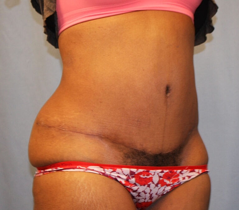 Abdominoplasty Tummy Tuck Before & After