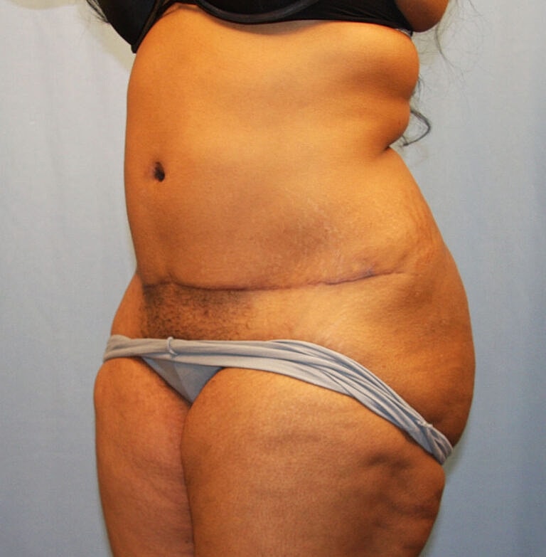 Abdominoplasty Tummy Tuck Before & After
