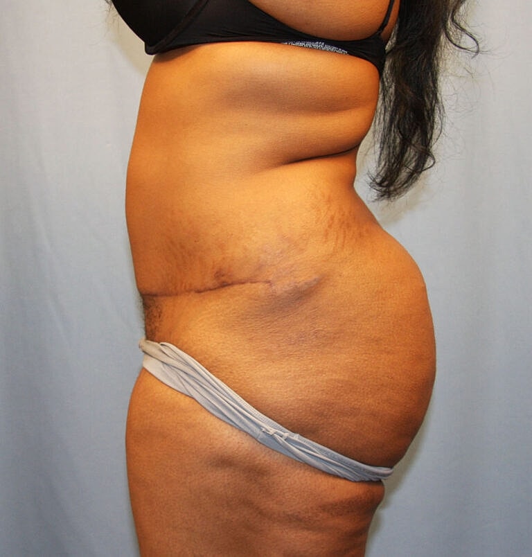 Abdominoplasty Tummy Tuck Before & After