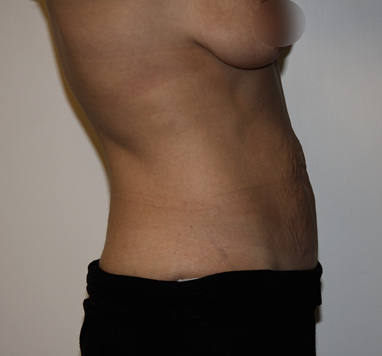 Abdominoplasty Tummy Tuck Before & After