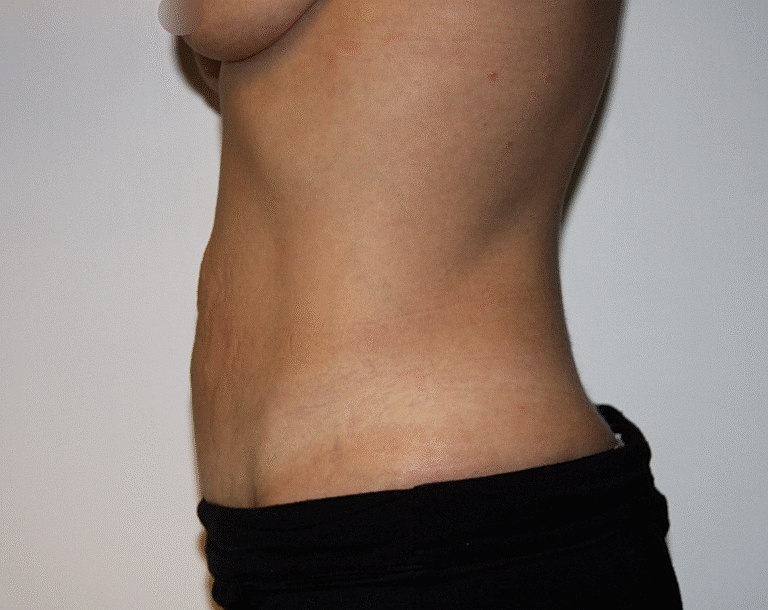 Abdominoplasty Tummy Tuck Before & After