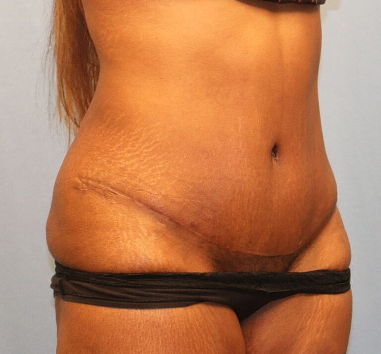 Abdominoplasty Tummy Tuck Before & After