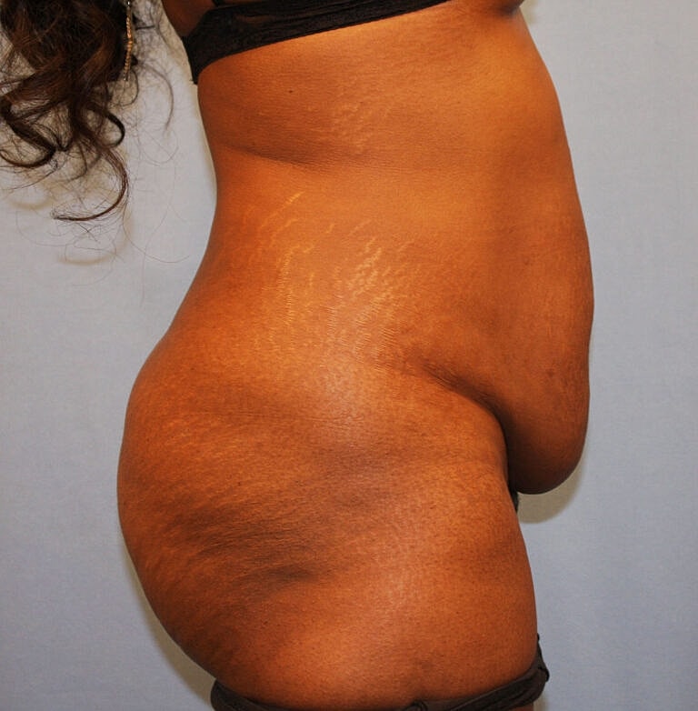 Abdominoplasty Tummy Tuck Before & After