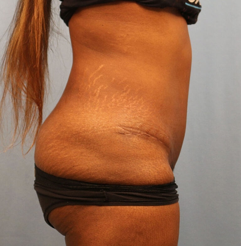 Abdominoplasty Tummy Tuck Before & After