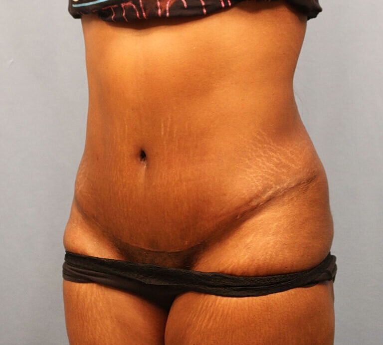 Abdominoplasty Tummy Tuck Before & After