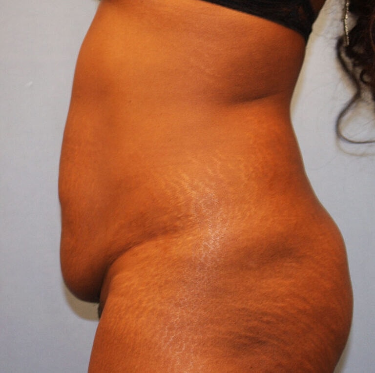 Abdominoplasty Tummy Tuck Before & After