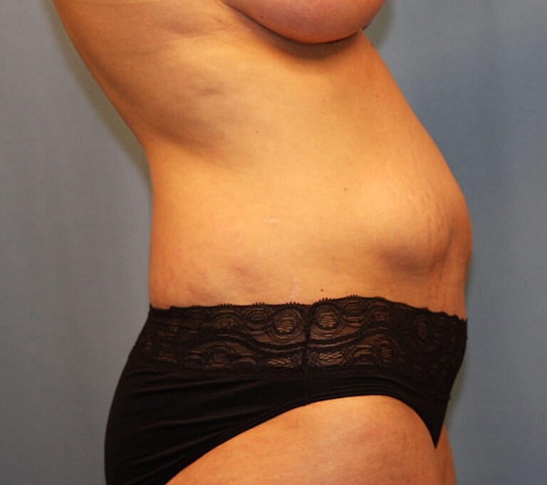 Abdominoplasty Tummy Tuck Before & After