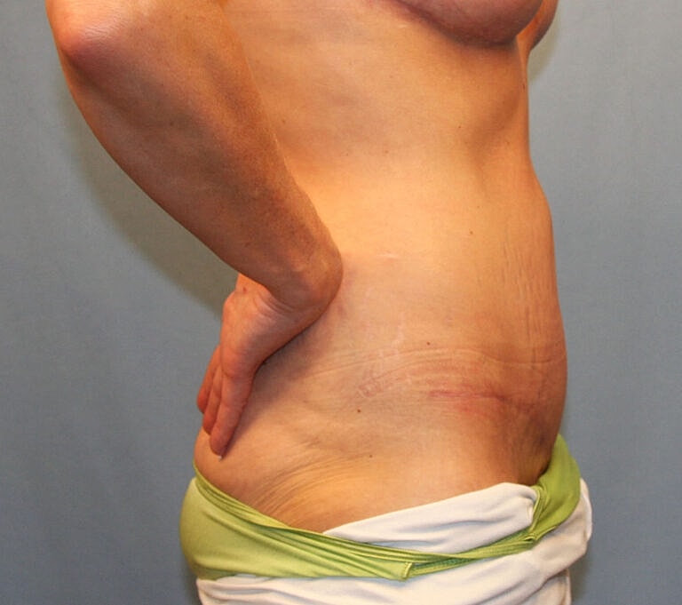 Abdominoplasty Tummy Tuck Before & After
