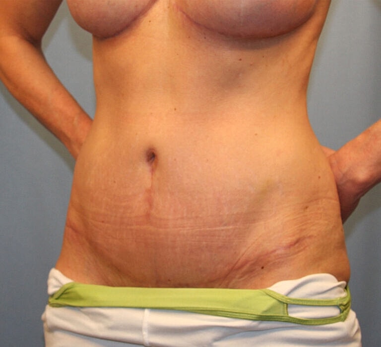 Abdominoplasty Tummy Tuck Before & After