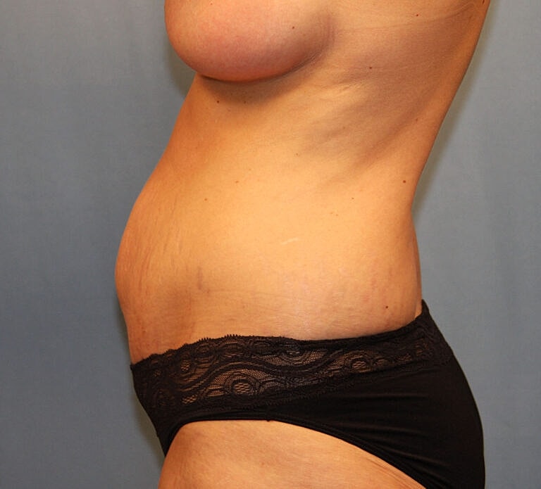 Abdominoplasty Tummy Tuck Before & After