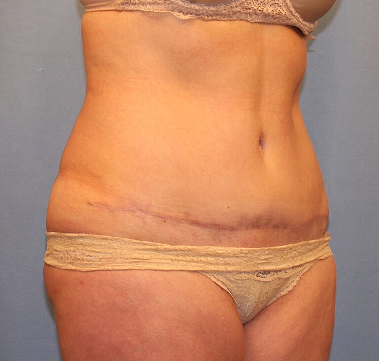 Abdominoplasty Tummy Tuck Before & After