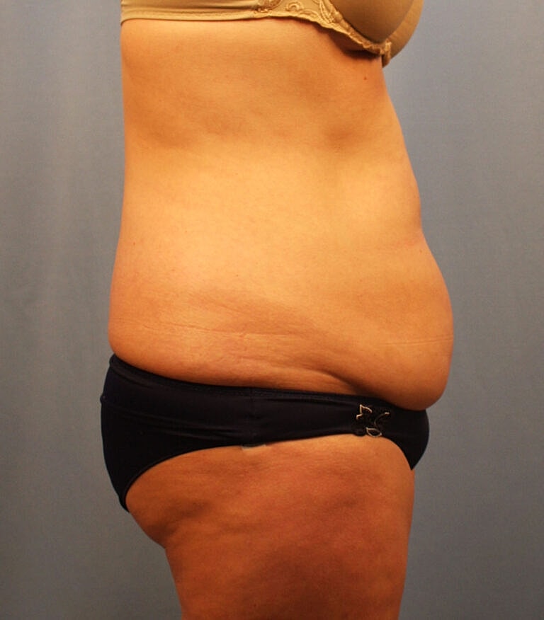Abdominoplasty Tummy Tuck Before & After