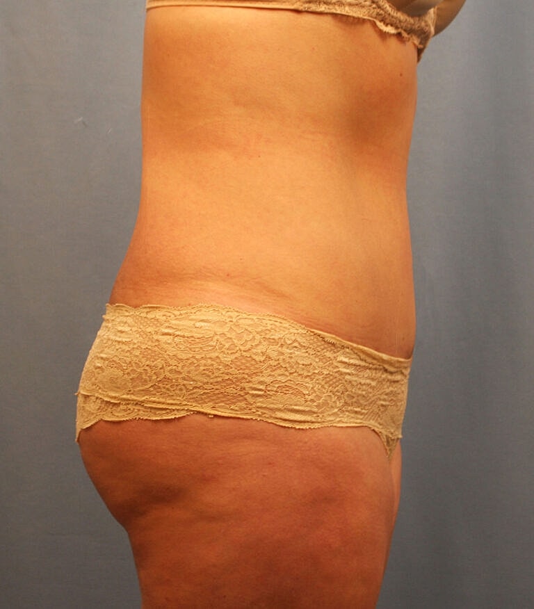 Abdominoplasty Tummy Tuck Before & After
