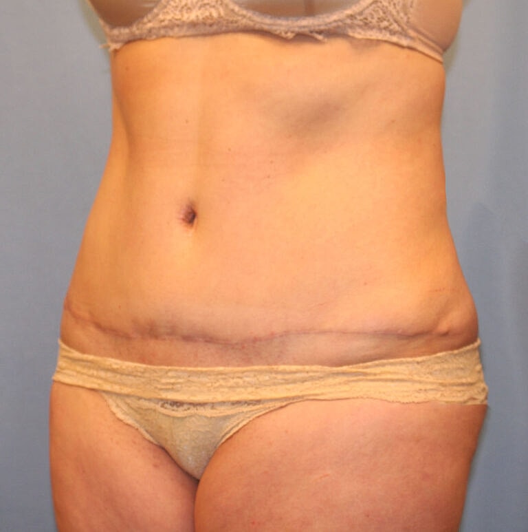 Abdominoplasty Tummy Tuck Before & After