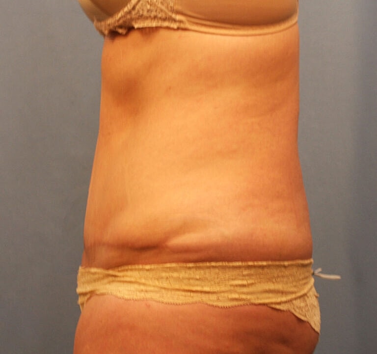 Abdominoplasty Tummy Tuck Before & After