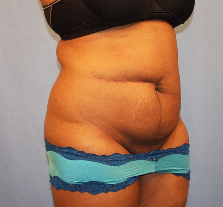Abdominoplasty Tummy Tuck Before & After