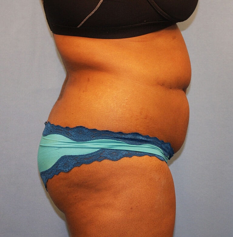 Abdominoplasty Tummy Tuck Before & After