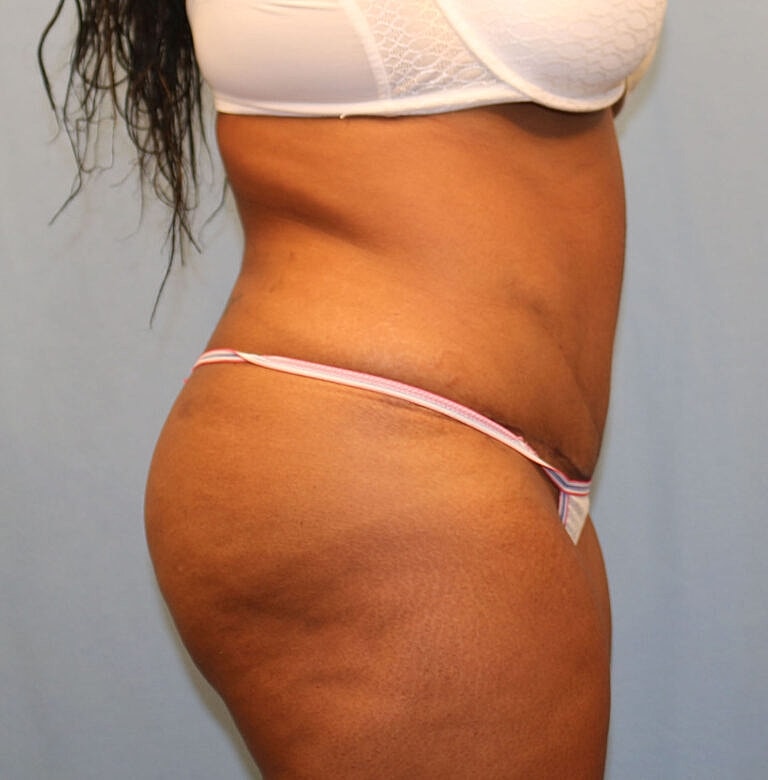 Abdominoplasty Tummy Tuck Before & After