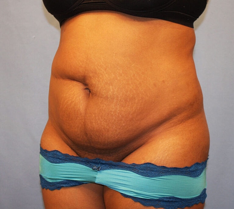 Abdominoplasty Tummy Tuck Before & After