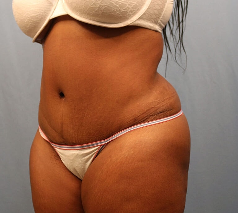 Abdominoplasty Tummy Tuck Before & After
