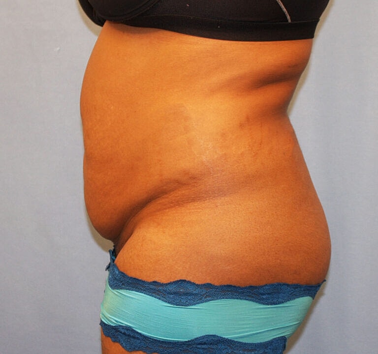 Abdominoplasty Tummy Tuck Before & After