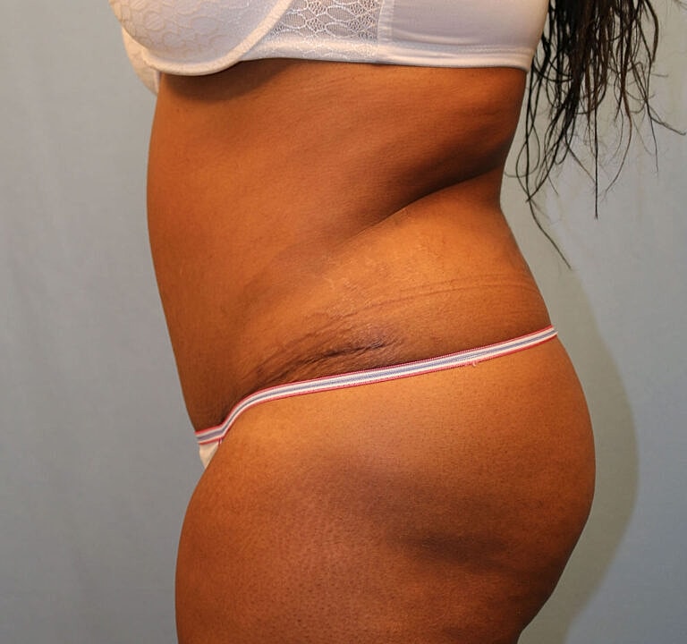 Abdominoplasty Tummy Tuck Before & After