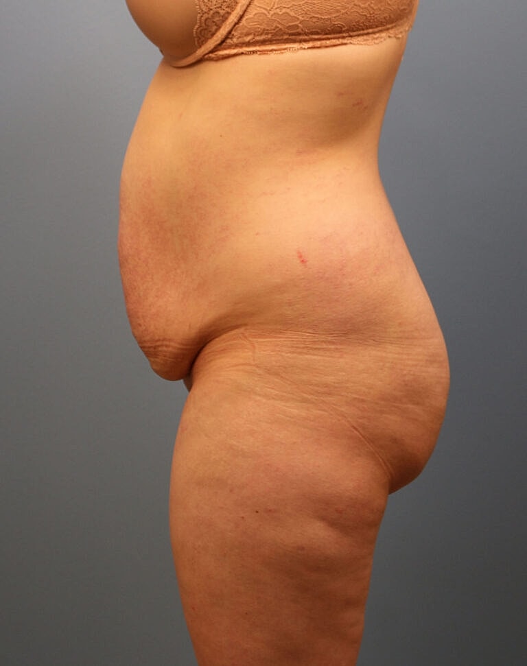 Abdominoplasty Tummy Tuck Before & After