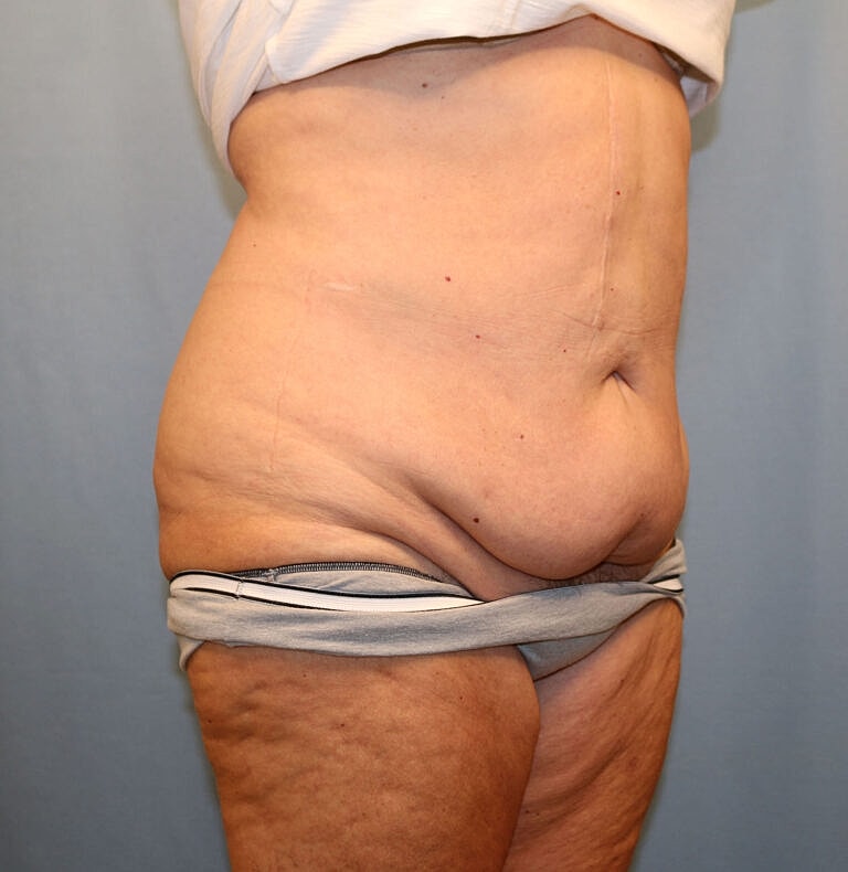 Abdominoplasty Tummy Tuck Before & After
