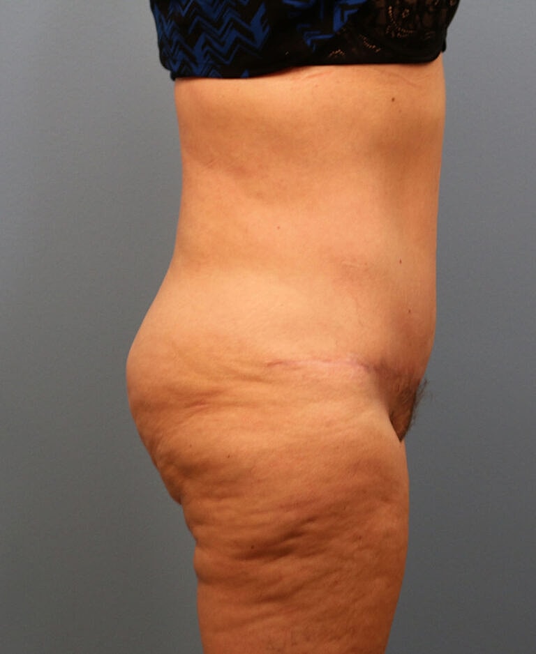 Abdominoplasty Tummy Tuck Before & After
