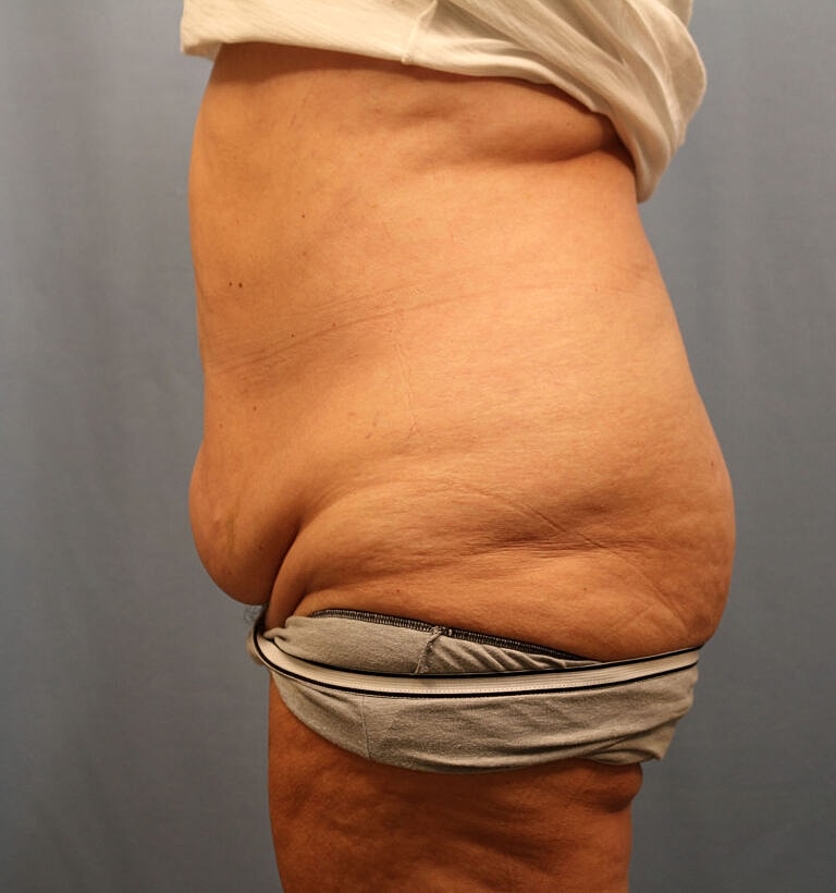 Abdominoplasty Tummy Tuck Before & After