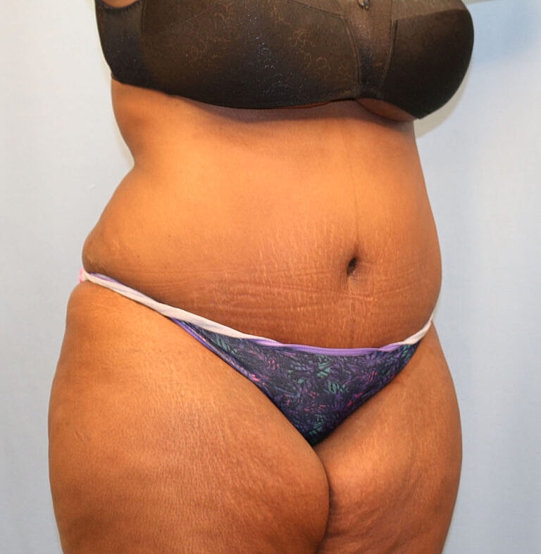 Abdominoplasty Tummy Tuck Before & After