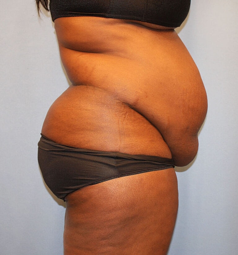Abdominoplasty Tummy Tuck Before & After