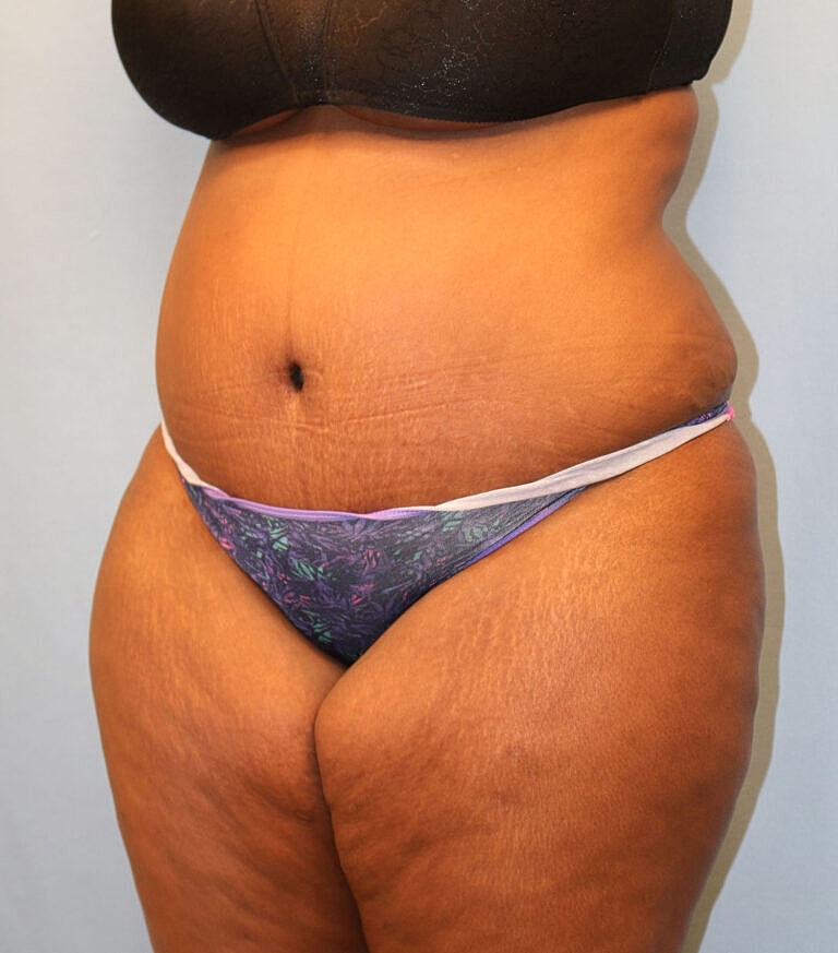 Abdominoplasty Tummy Tuck Before & After