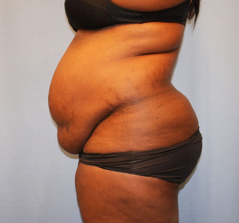 Abdominoplasty Tummy Tuck Before & After