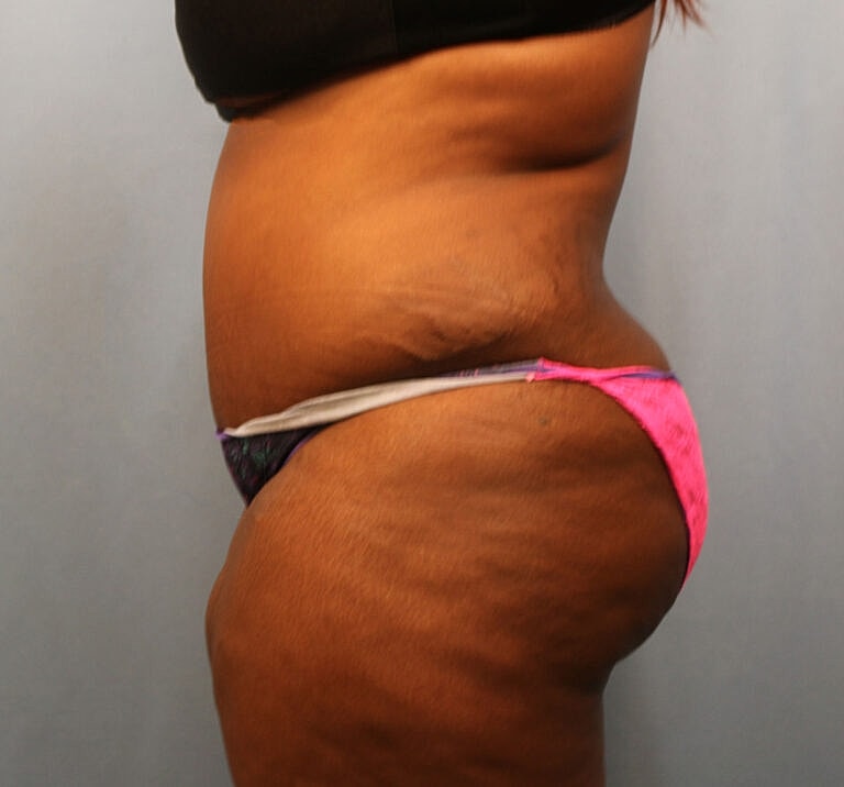 Abdominoplasty Tummy Tuck Before & After
