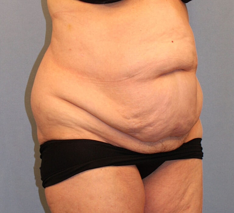 Abdominoplasty Tummy Tuck Before & After