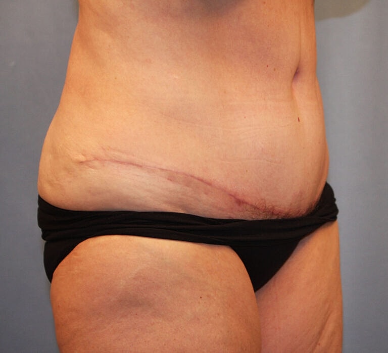 Abdominoplasty Tummy Tuck Before & After