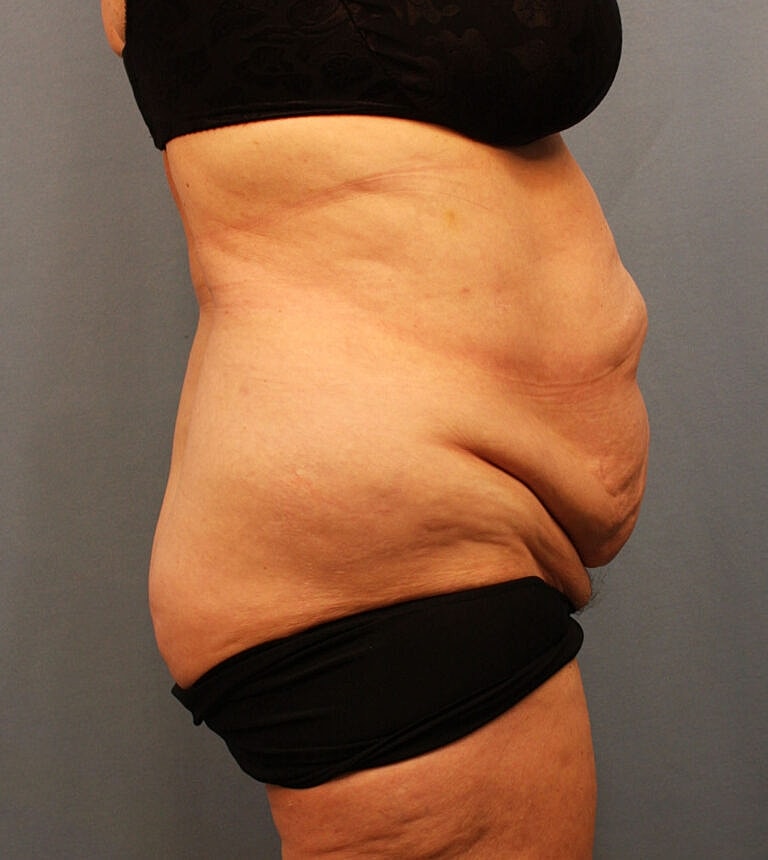 Abdominoplasty Tummy Tuck Before & After