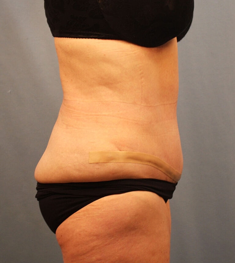 Abdominoplasty Tummy Tuck Before & After