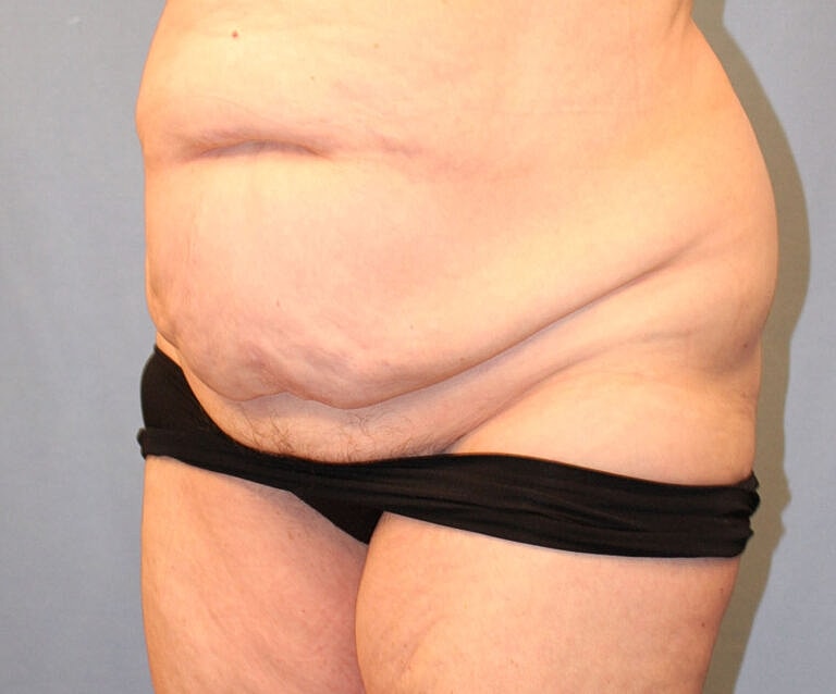 Abdominoplasty Tummy Tuck Before & After