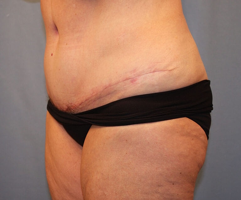 Abdominoplasty Tummy Tuck Before & After