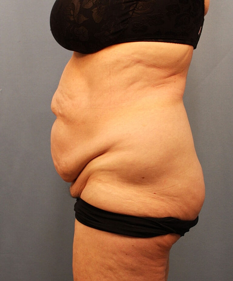 Abdominoplasty Tummy Tuck Before & After