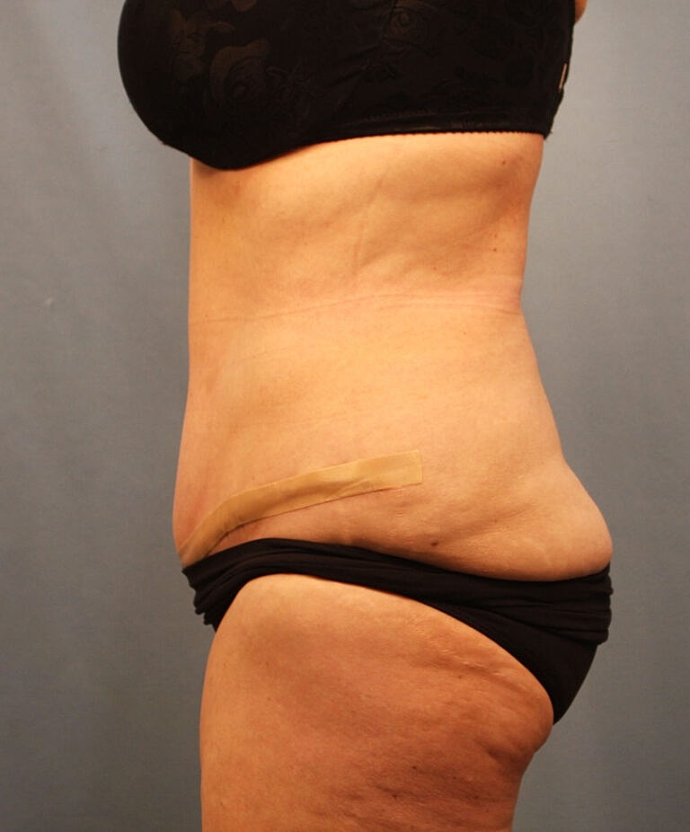 Abdominoplasty Tummy Tuck Before & After