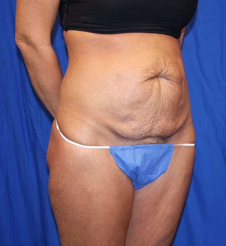 Abdominoplasty Tummy Tuck Before & After