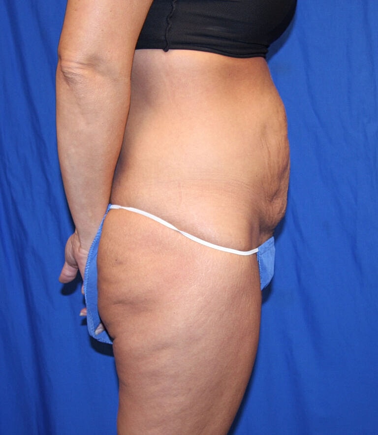 Abdominoplasty Tummy Tuck Before & After