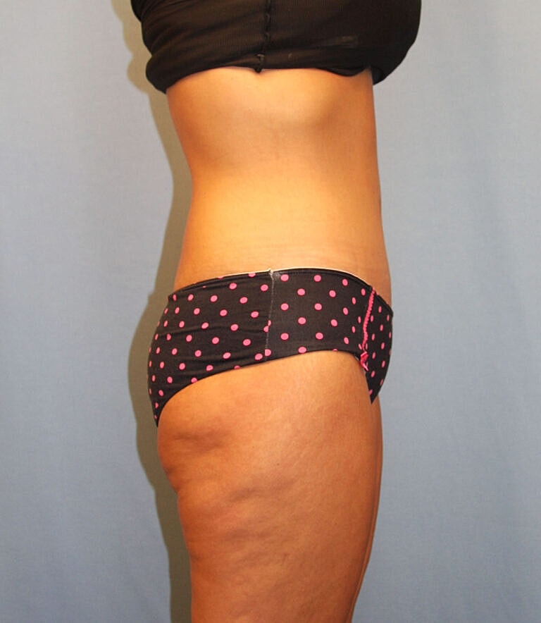 Abdominoplasty Tummy Tuck Before & After