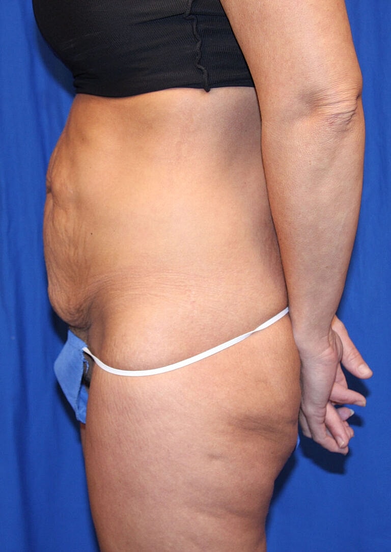 Abdominoplasty Tummy Tuck Before & After