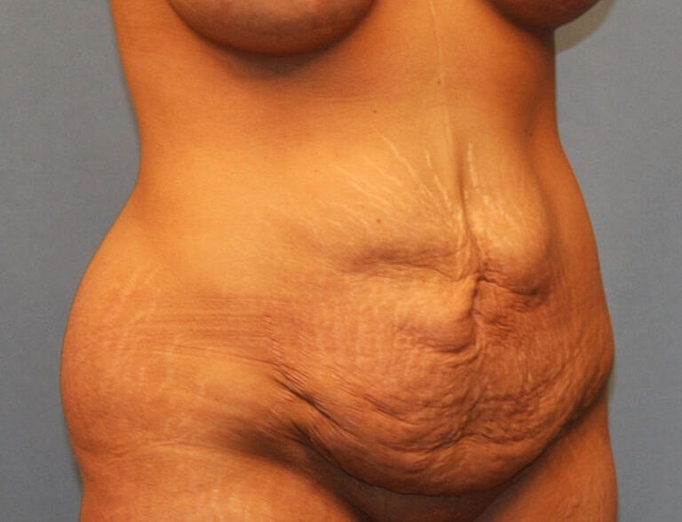 Abdominoplasty Tummy Tuck Before & After