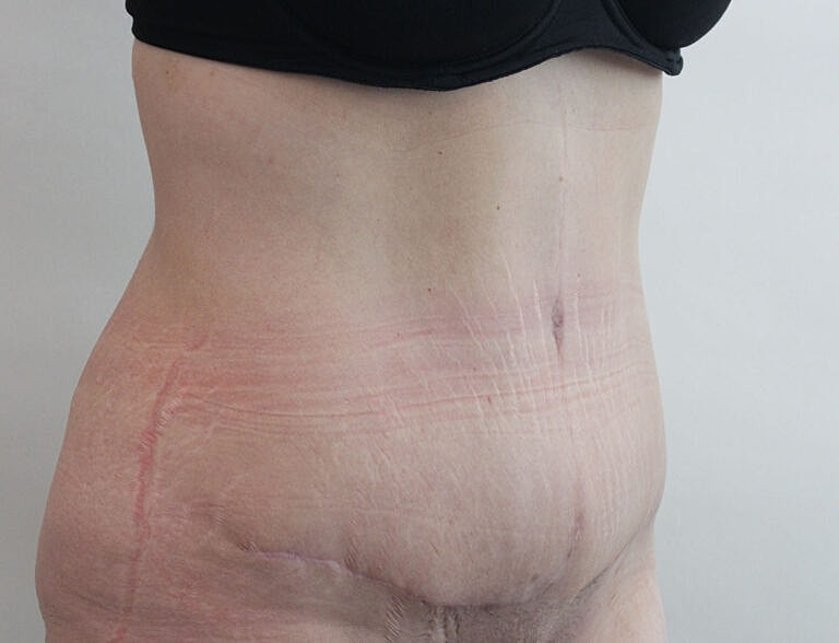 Abdominoplasty Tummy Tuck Before & After
