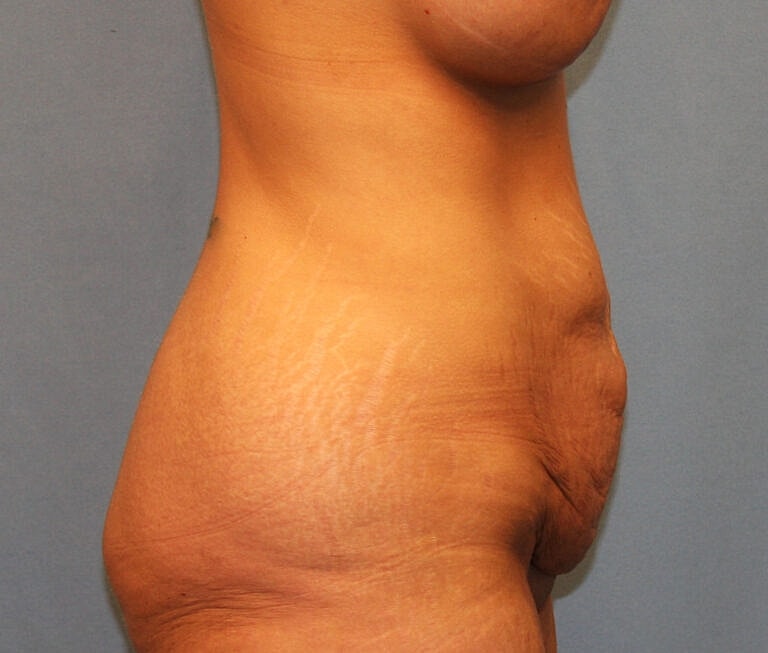 Abdominoplasty Tummy Tuck Before & After
